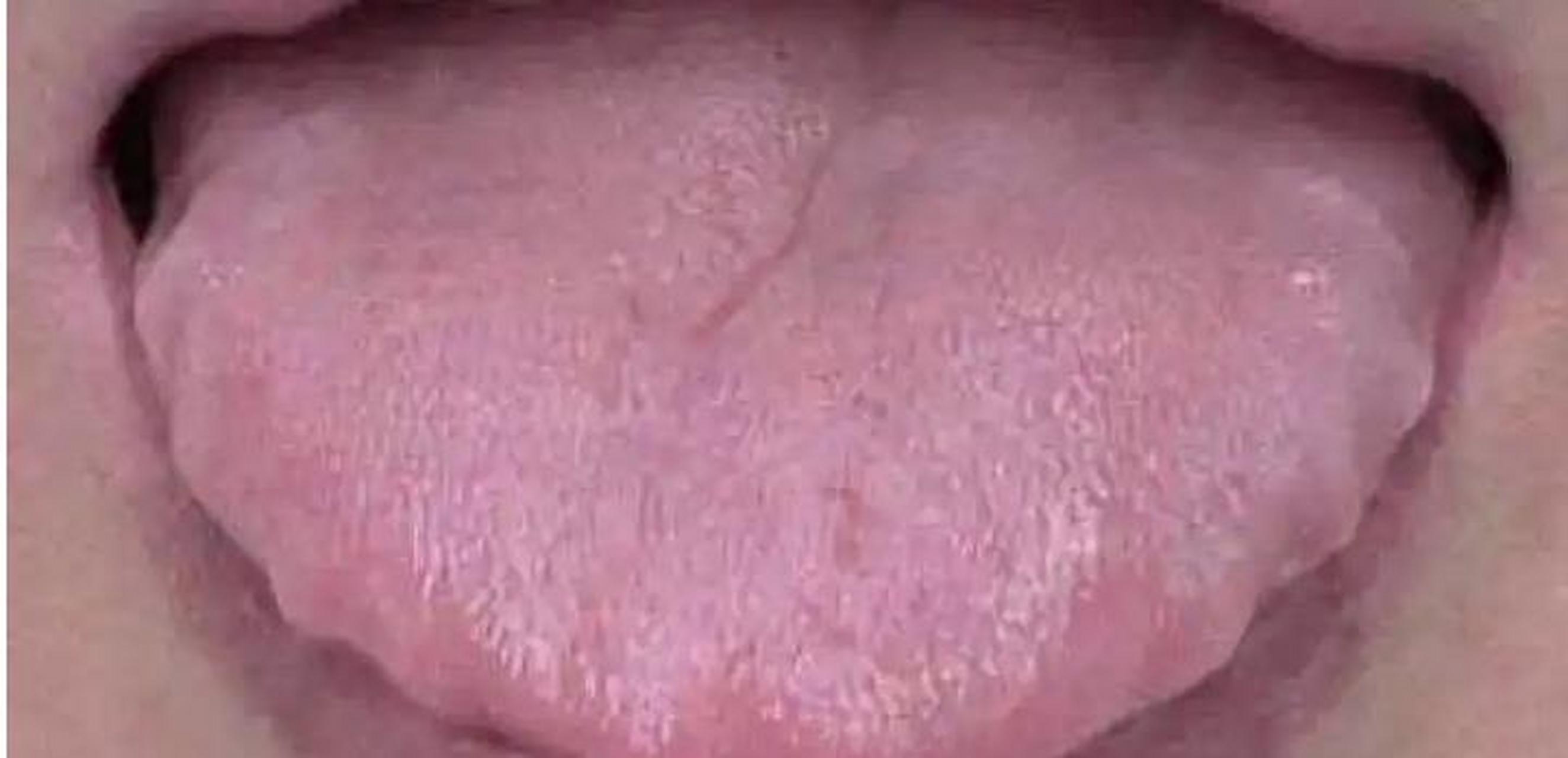 4种齿痕舌,不全是湿气重,身体问题各不同 1,脾气不足:舌苔干净,舌体胖