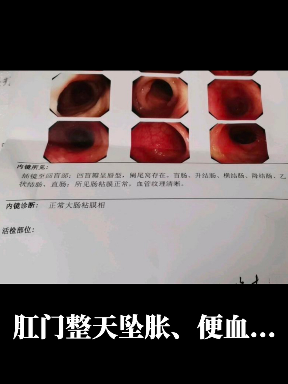 肛门整天坠胀,便血.