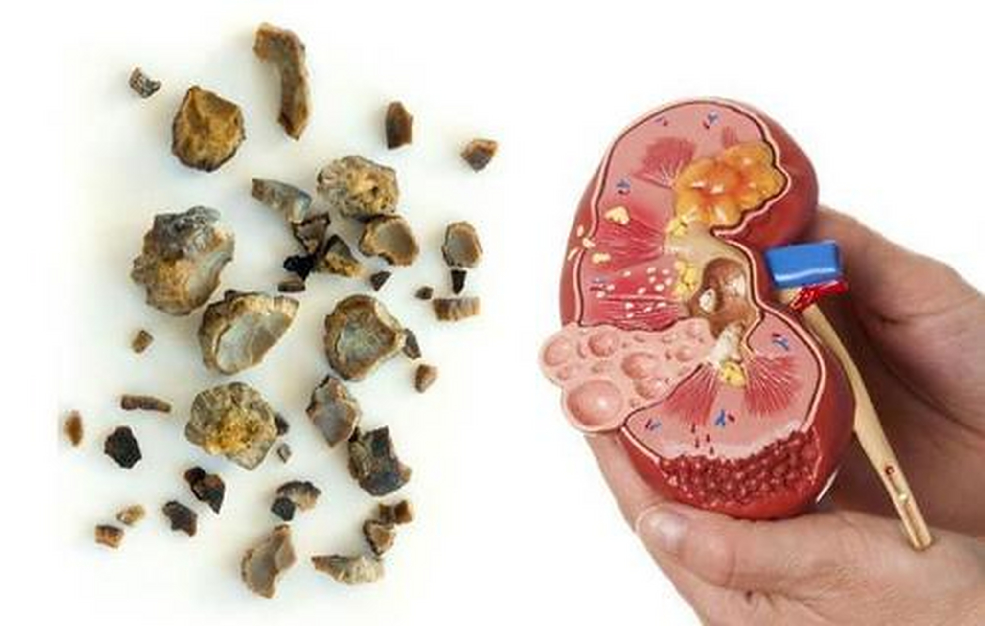 一旦患上肾结石,多喝水对治愈疾病来说作用不大,而且并不是所有的肾