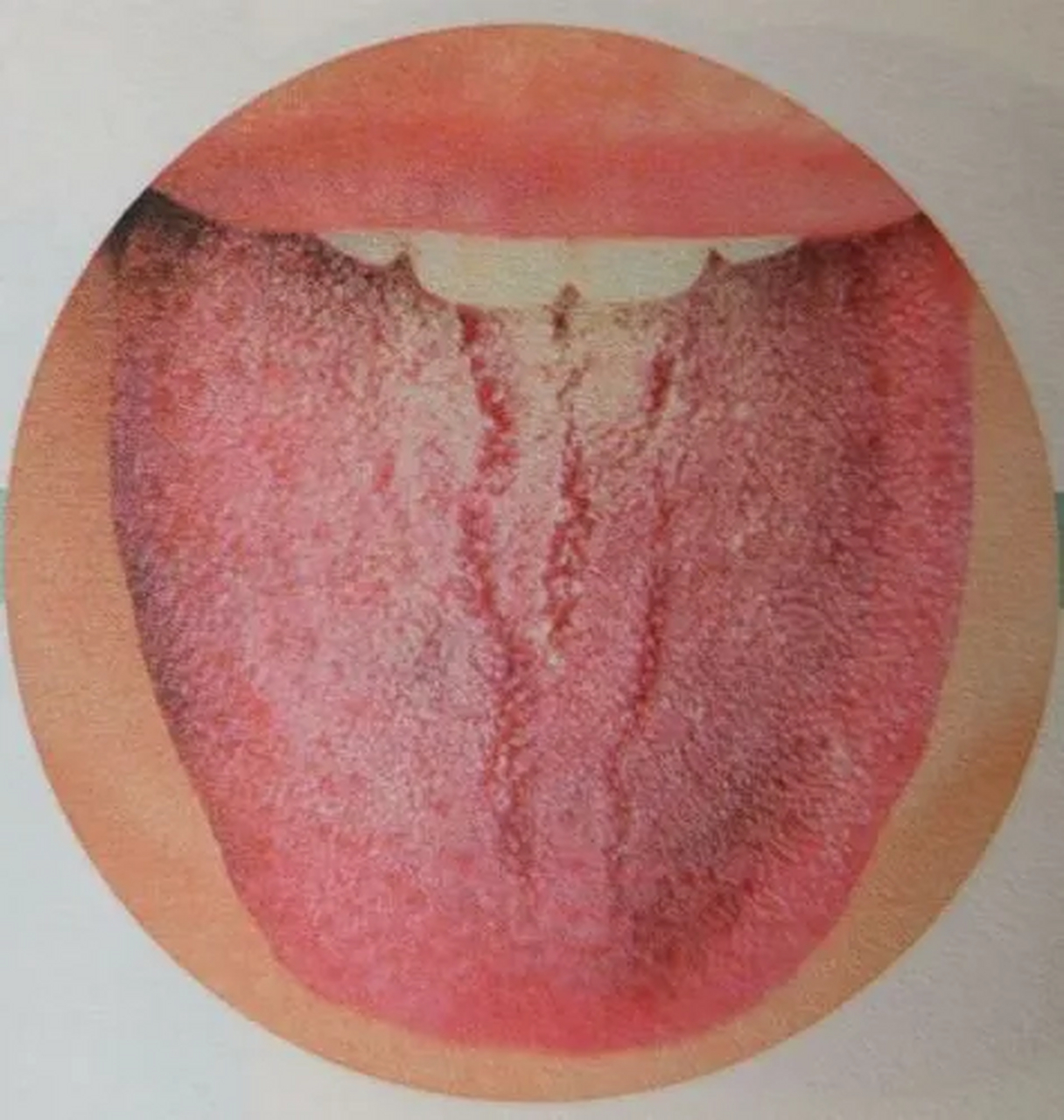 舌头有裂纹图解图片