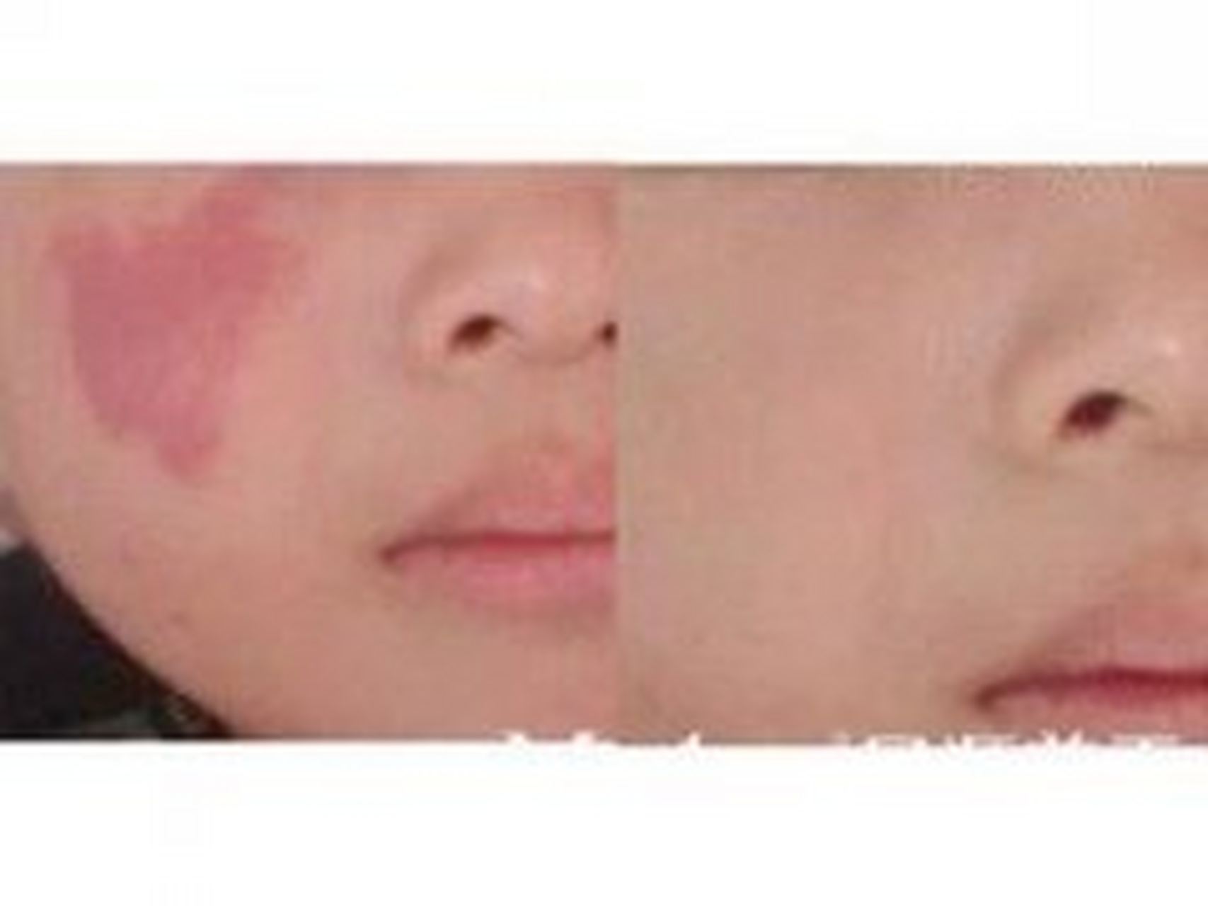 做皮秒去胎记,让您秒变美肌女神   "皮秒能去胎记吗?