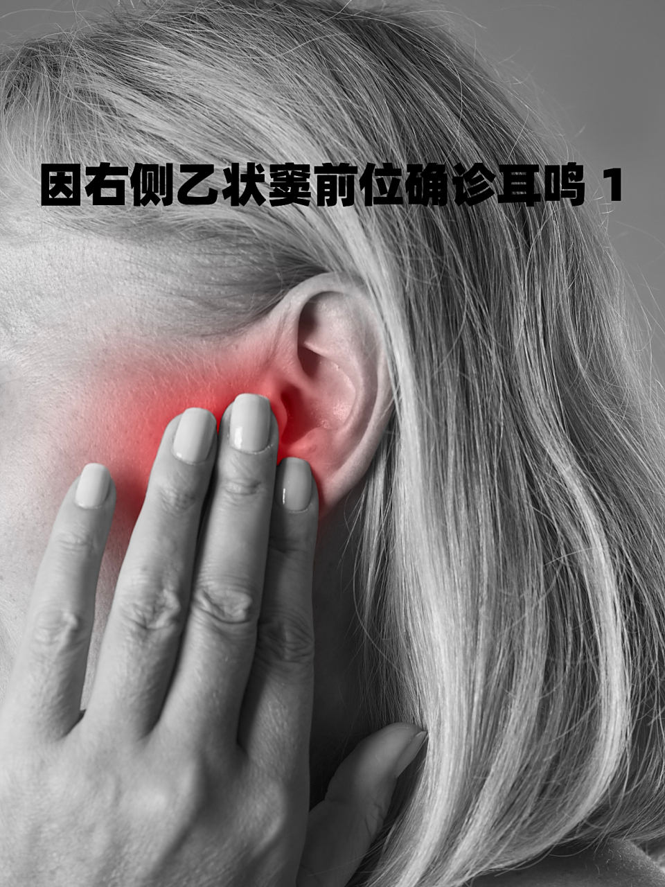 因右侧乙状窦前位确诊耳鸣 1  #耳鸣#  最近一周总感觉耳朵嗡嗡做响