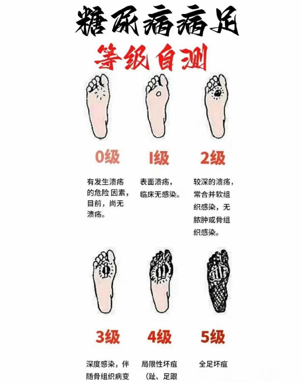 糖尿病足分级以及图片图片