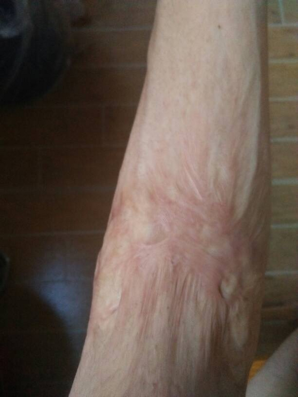 处理烫伤疤痕的最佳时间是在伤口完全愈合后开始,通常为烫伤后的2至