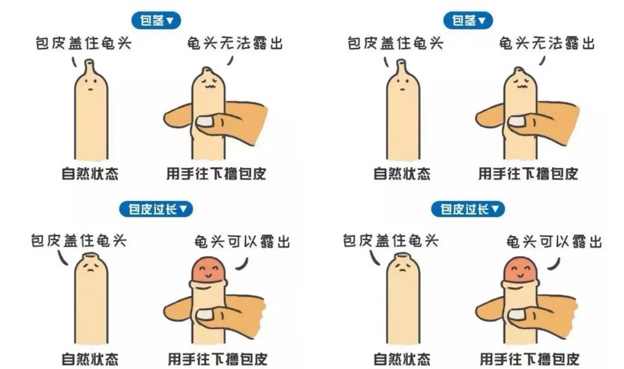 潍坊博大医院#博大医院男性小常识分享:包皮过长,什么情况下需要手术