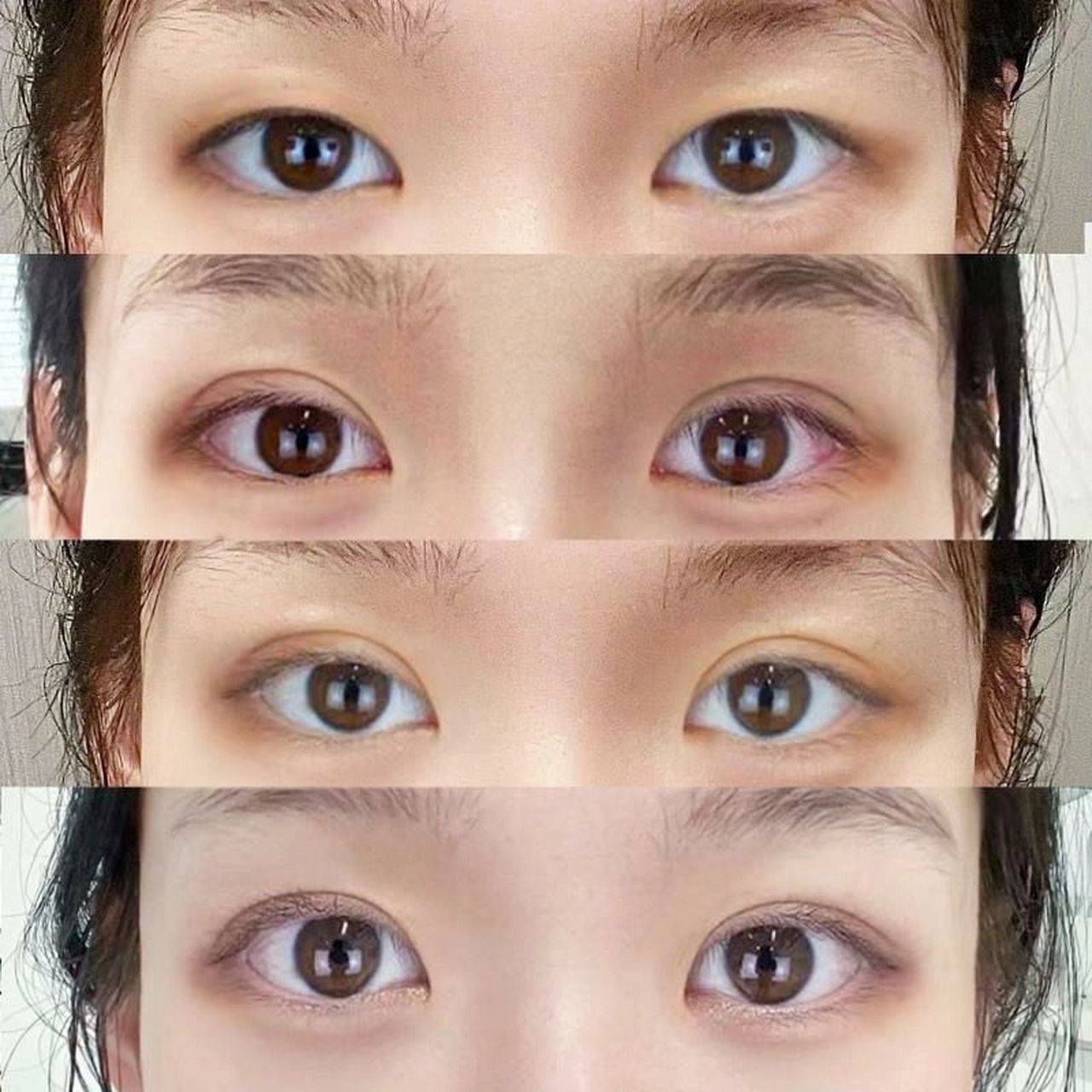 一般来说,医生在判断是否需要开内眼角的依据就是有无内眦赘皮,以及