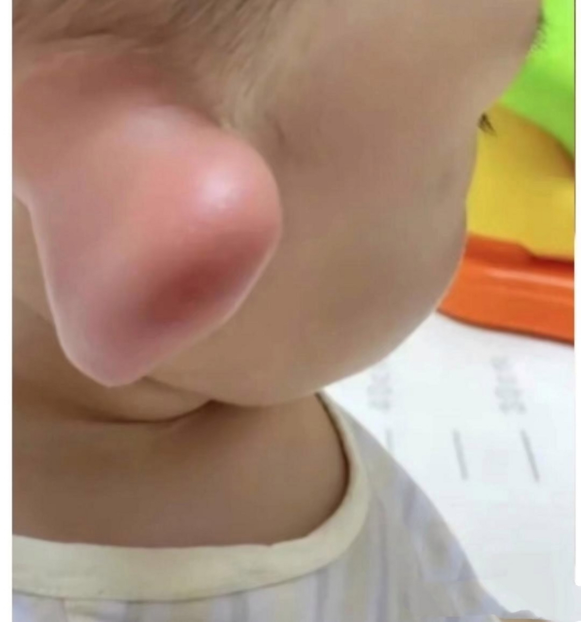 也不知道被什么蜜蜂盯了一下,结果儿子耳朵就肿成顺风耳了,好心疼