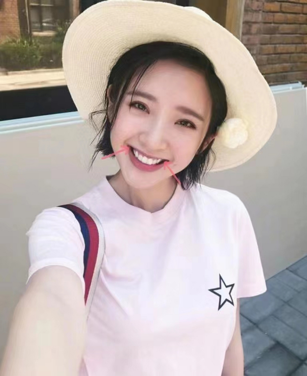 颊廊又称颊旁间隙,负性间隙,是微笑时两侧口角和最后一颗可见牙齿颊