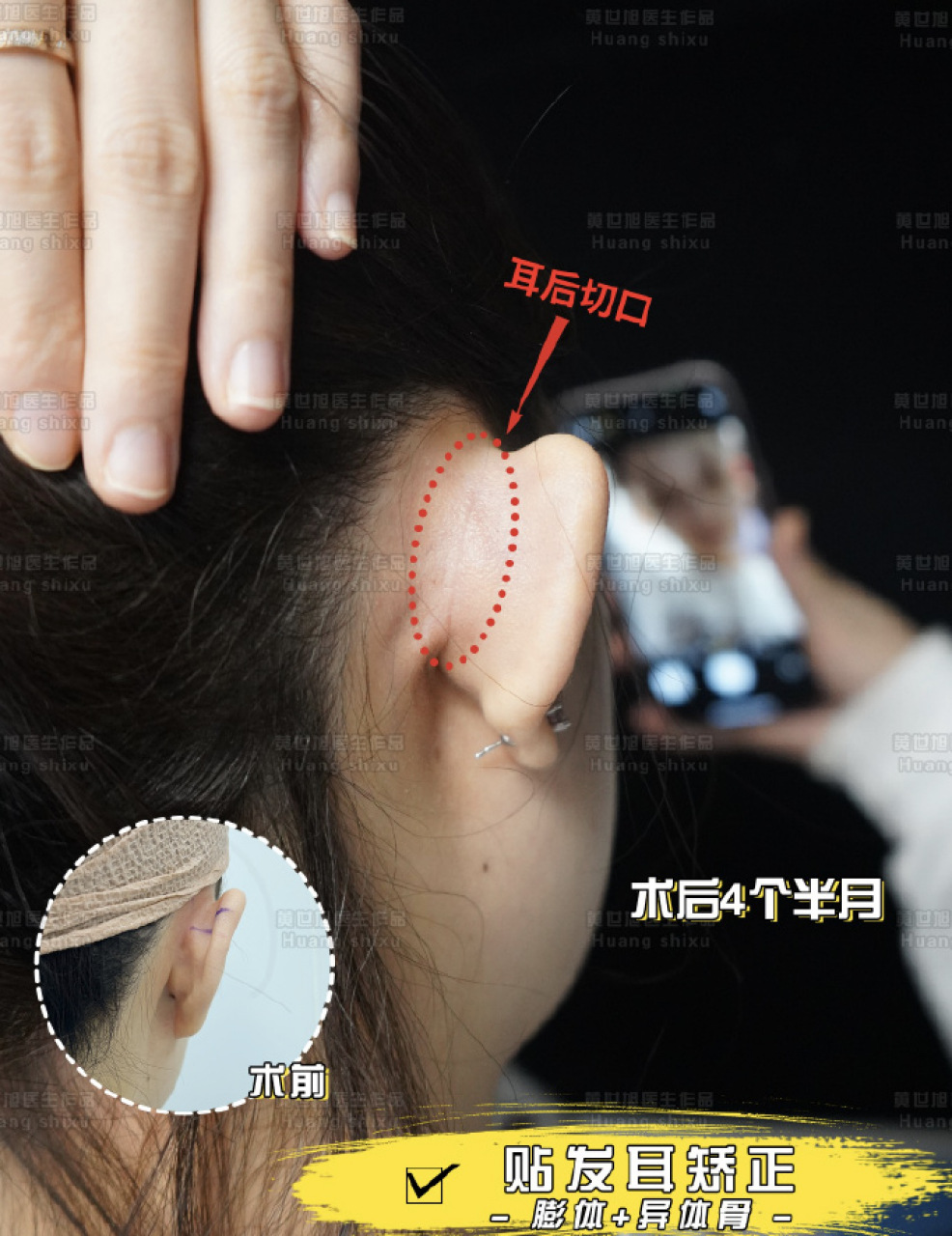 精灵耳# #幼态精灵耳# #贴发耳矫正# #耳后切口