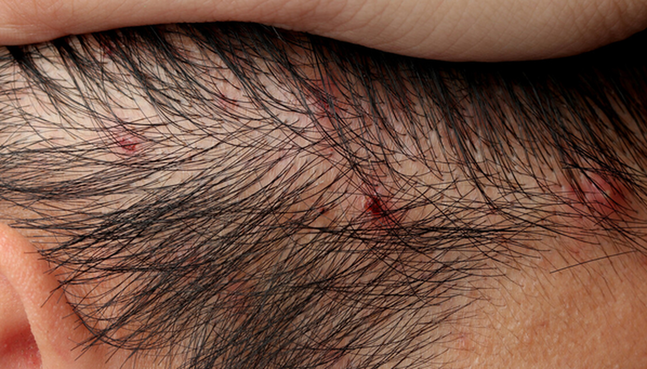 现在头皮感觉舒服了,红疹也