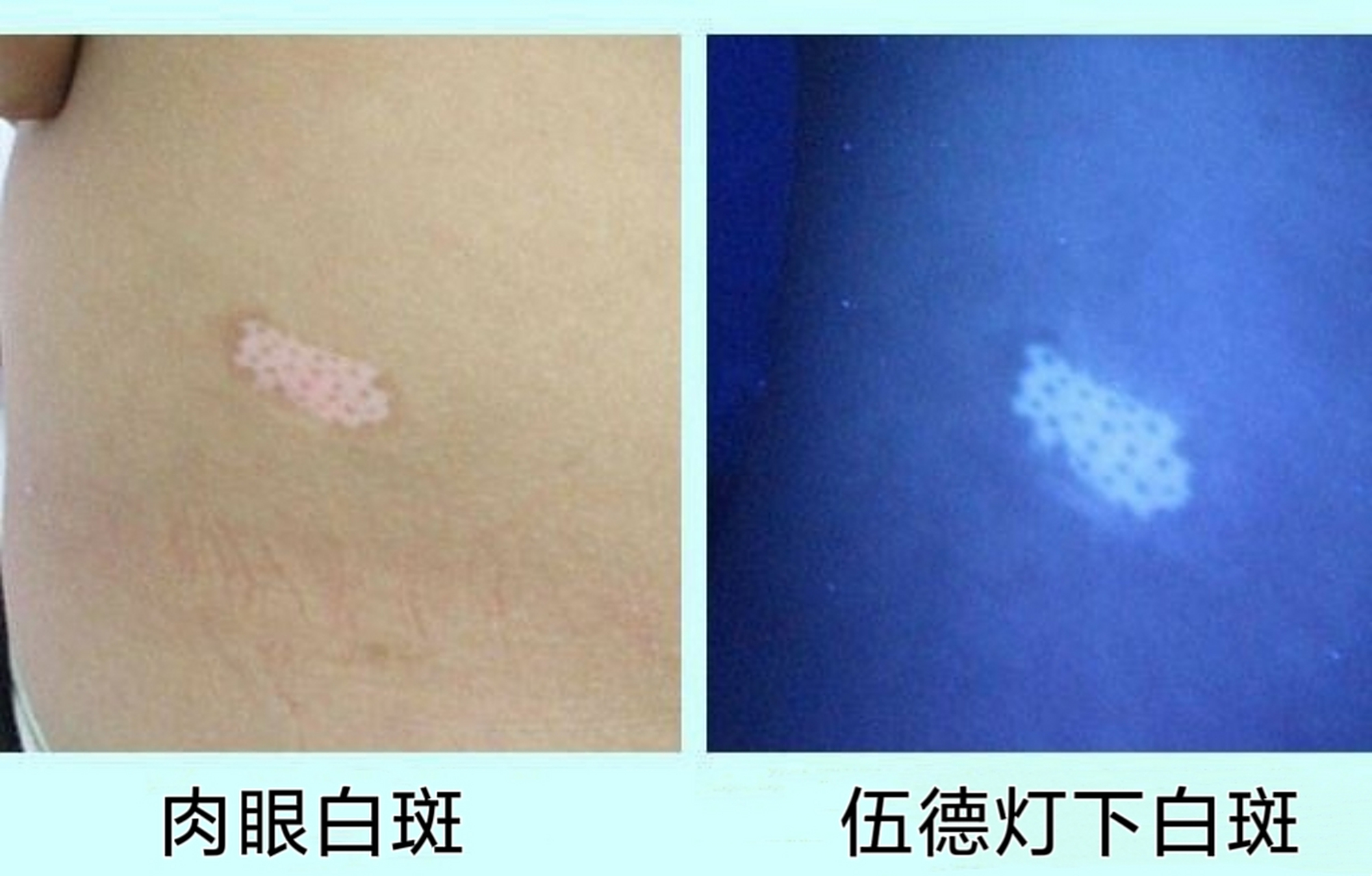 伍德灯下的白癜风呈现亮白色或者偏蓝色的荧光  下图是:肉眼白斑图和