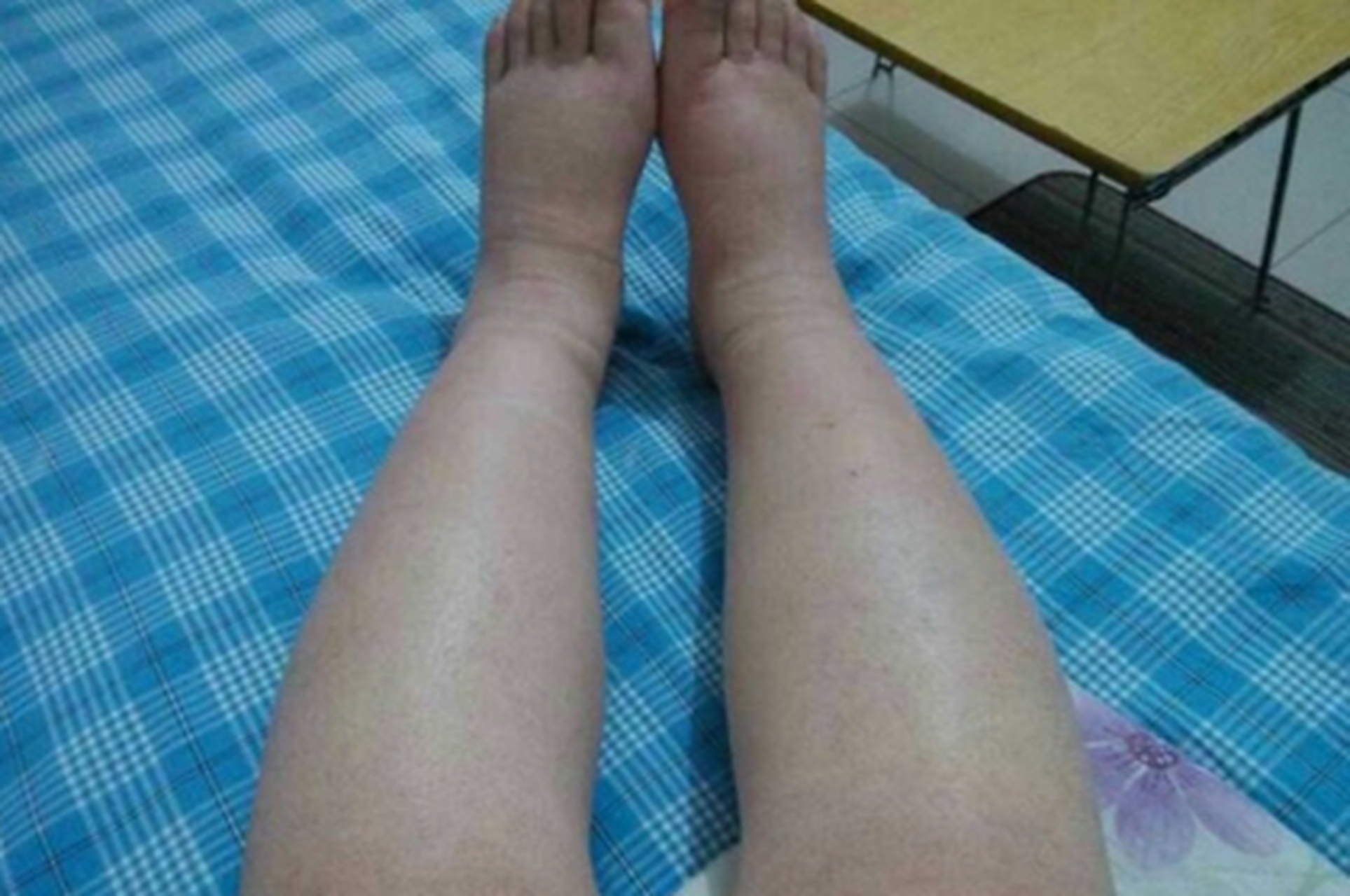 49岁的王女士因颜面及双下肢浮肿,于当地医院检查考虑肾病综合征,遂