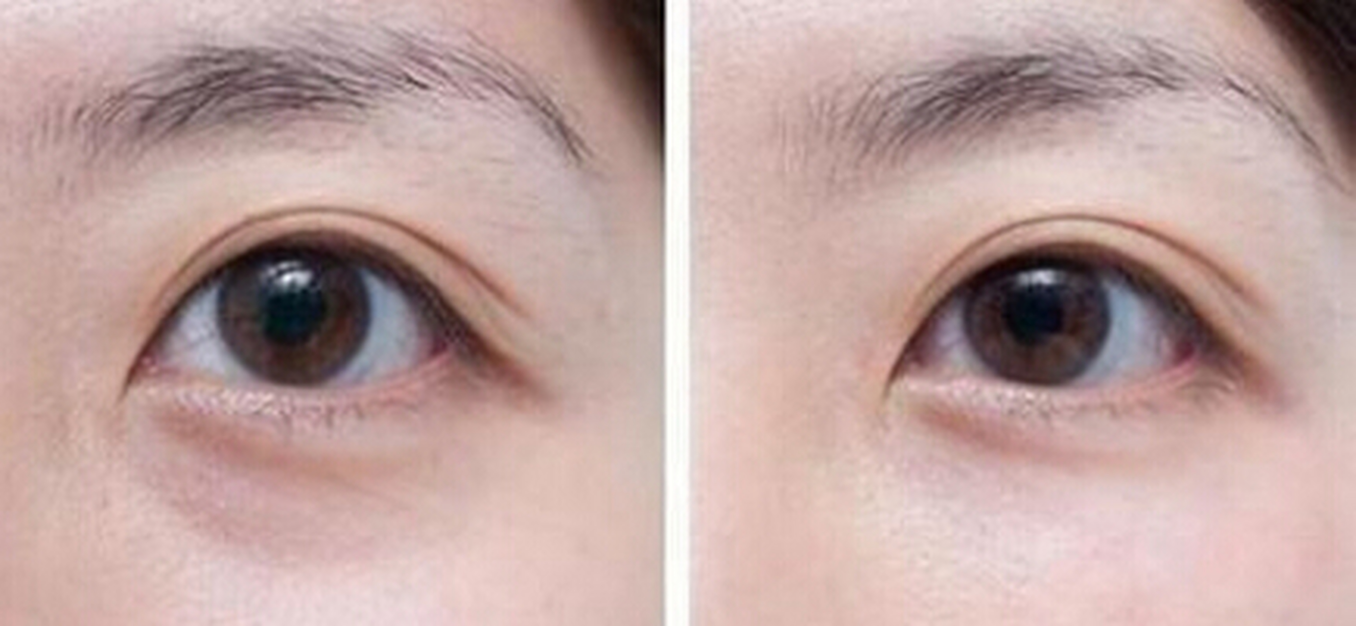 改善泪沟的3种方式,你会选哪种?