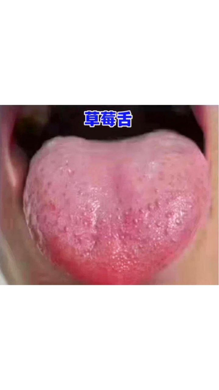 2,舌苔厚腻发黄:多半是脾胃虛弱,运化失利,胃热湿滞