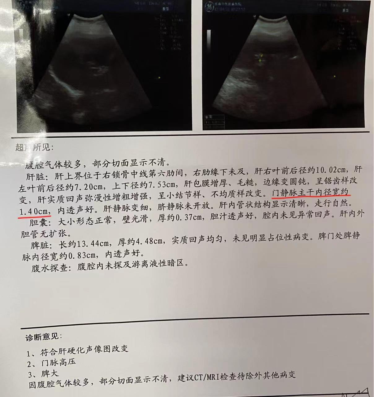 酒精肝# #酒精性肝硬化#  昨天下午接诊了一位47岁的患者,他最近一直