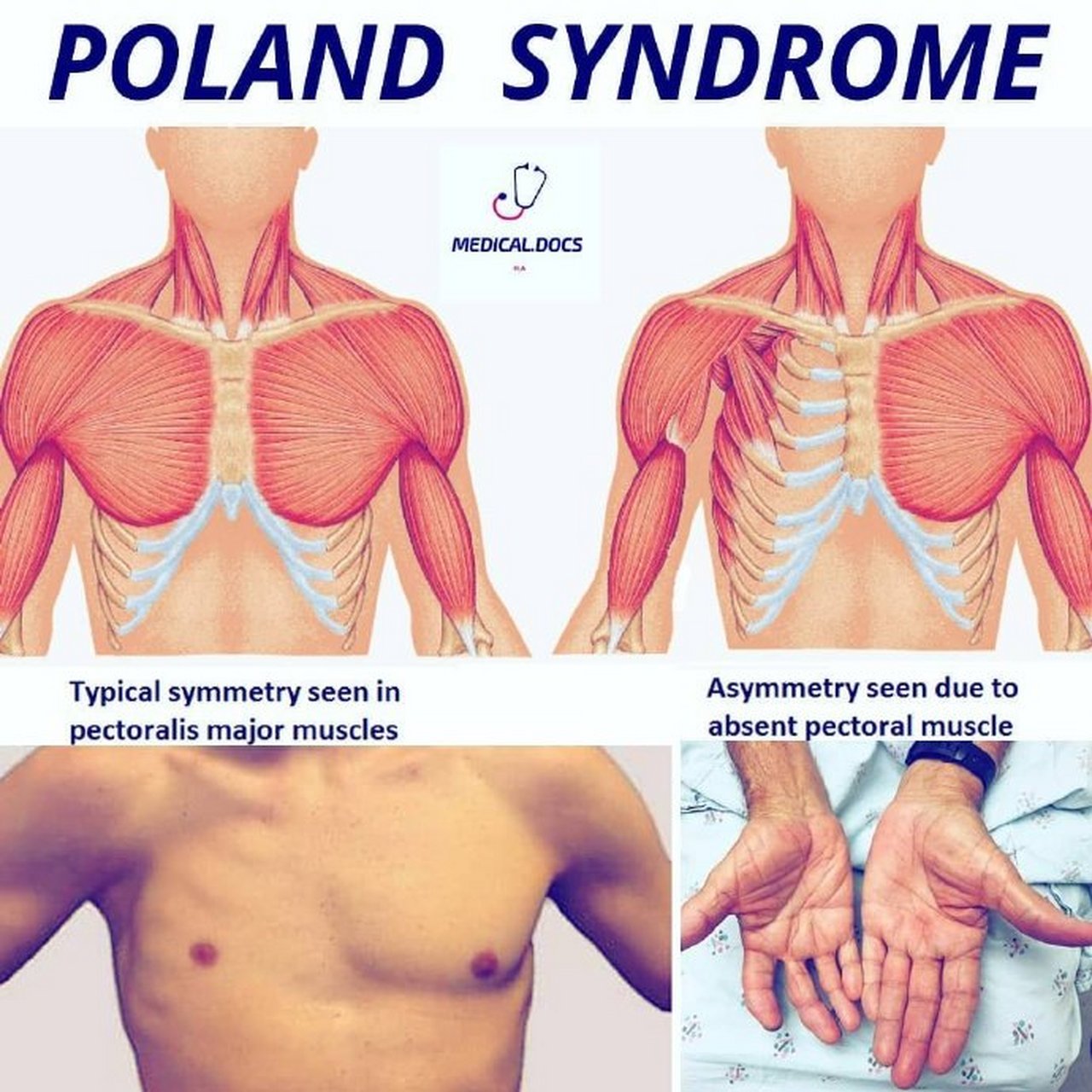 【poland综合症(poland syndrome)】是一组少见但合并有多种畸形的