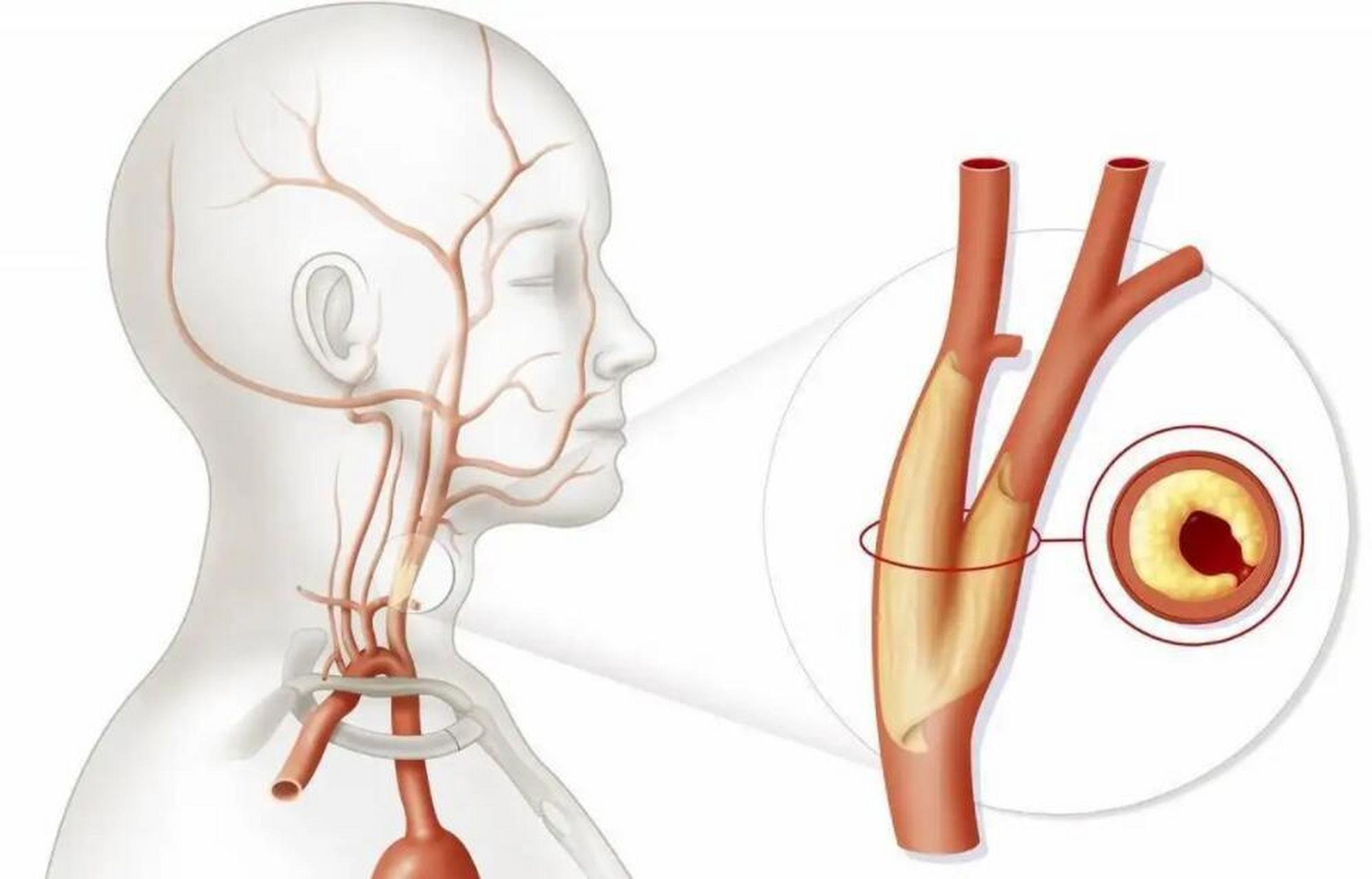双侧颈动脉斑块,狭窄78%,不用手术,中药1方缩小斑块 62岁的张某,男性
