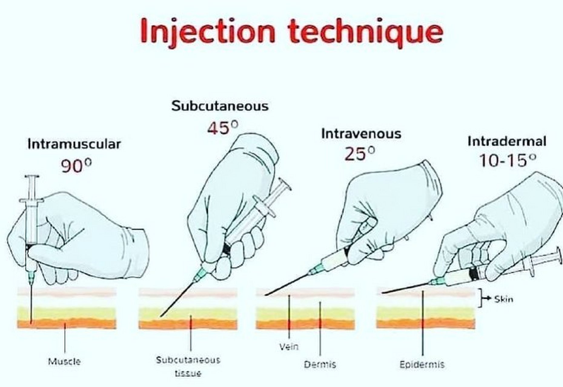皮内注射角度图片