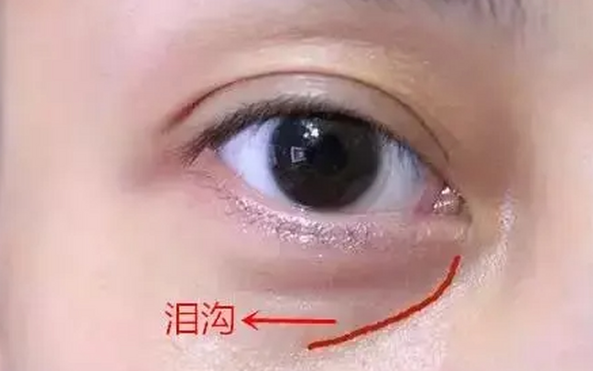 玻尿酸填充泪沟一般采用双平面注射法,在骨膜层或在皮下组织层进行