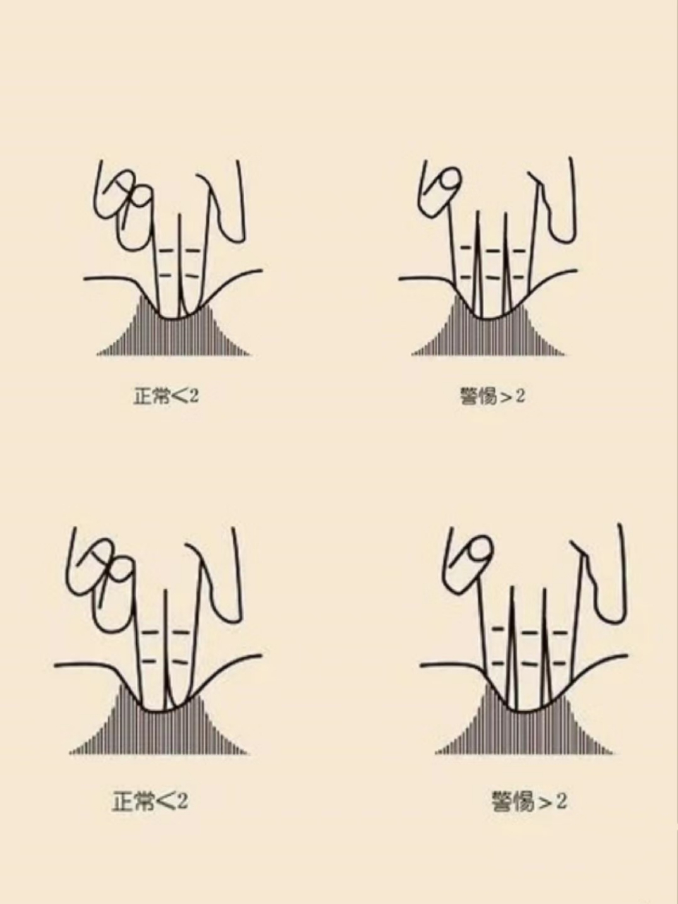 90教你一招动态查体方法,在家【1分钟】自测腹直肌分离程度75