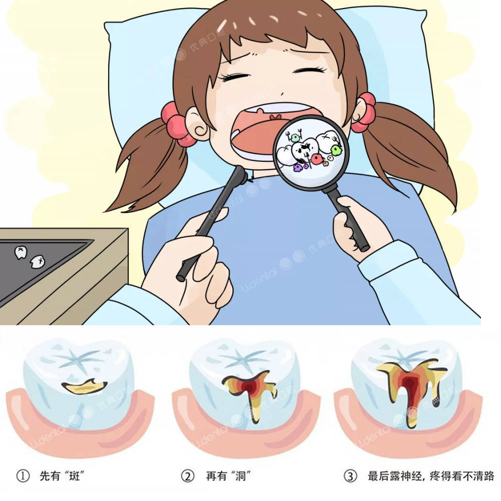 蛀牙形成的图片卡通图片