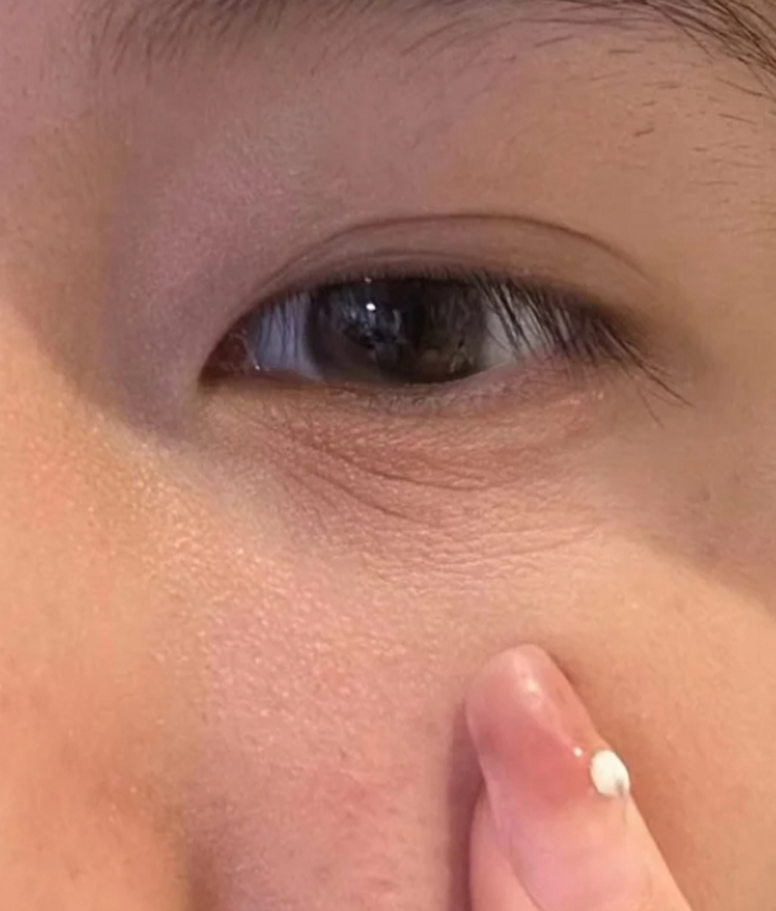 眼部干纹和细纹区别图 #医美科普挑战赛#  眼部干纹和细纹是许多人