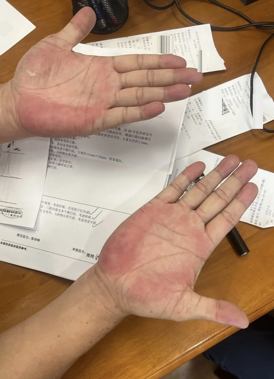 这就是肝掌,非常典型,很明显的就能看出,手掌的大小鱼际处发红,有的