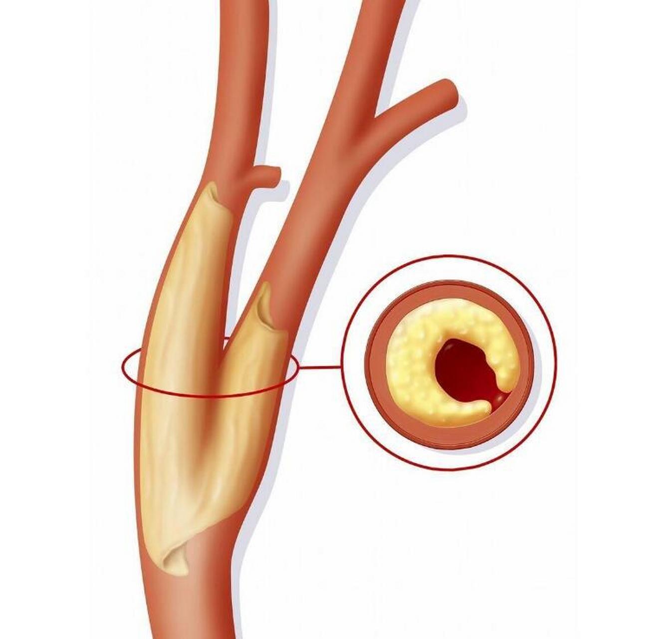 血管斑块图示图片