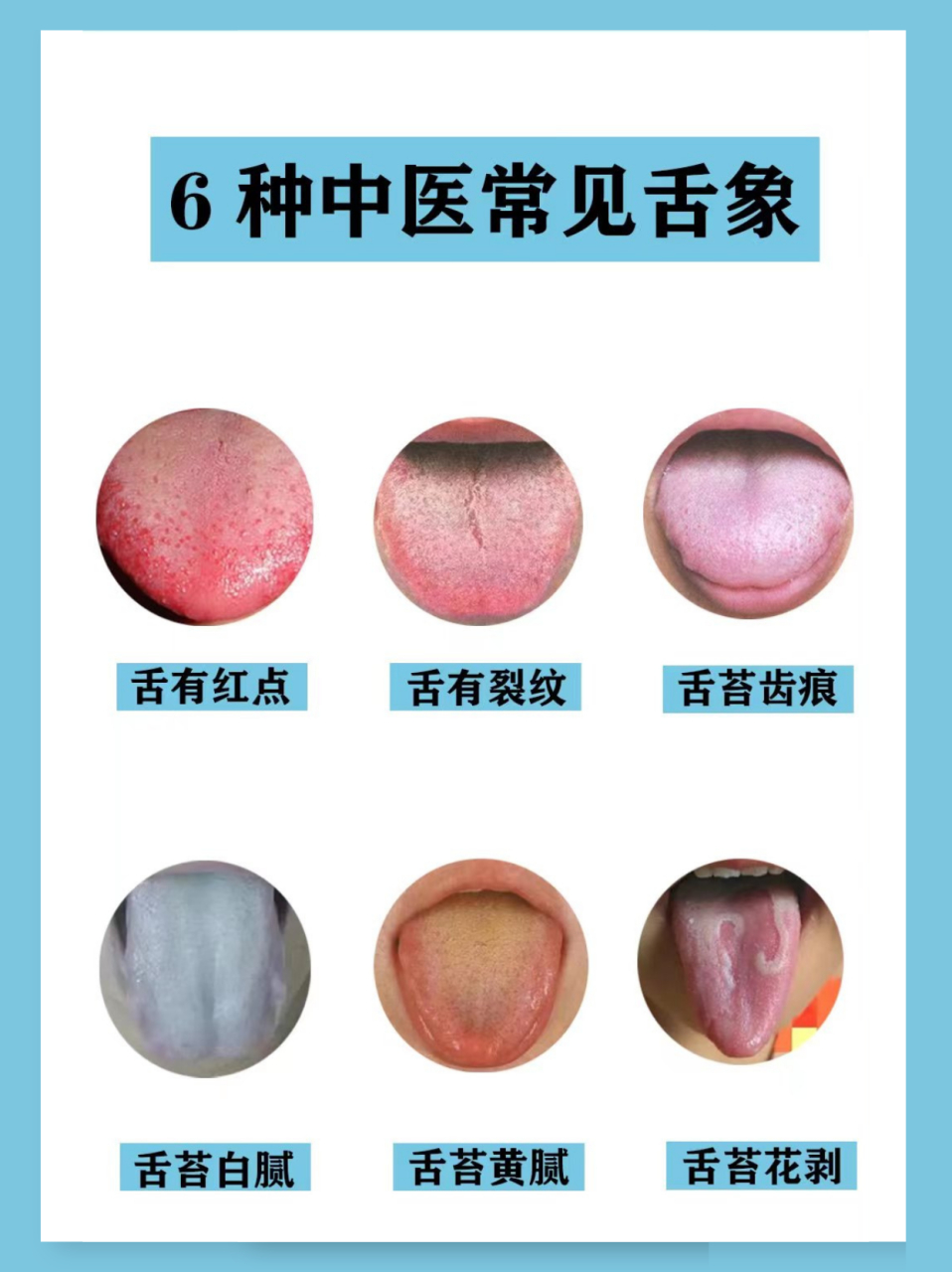 6种中医常见舌象 帮你辨证分析 #生活# #中医# #健康# #舌苔# #中医