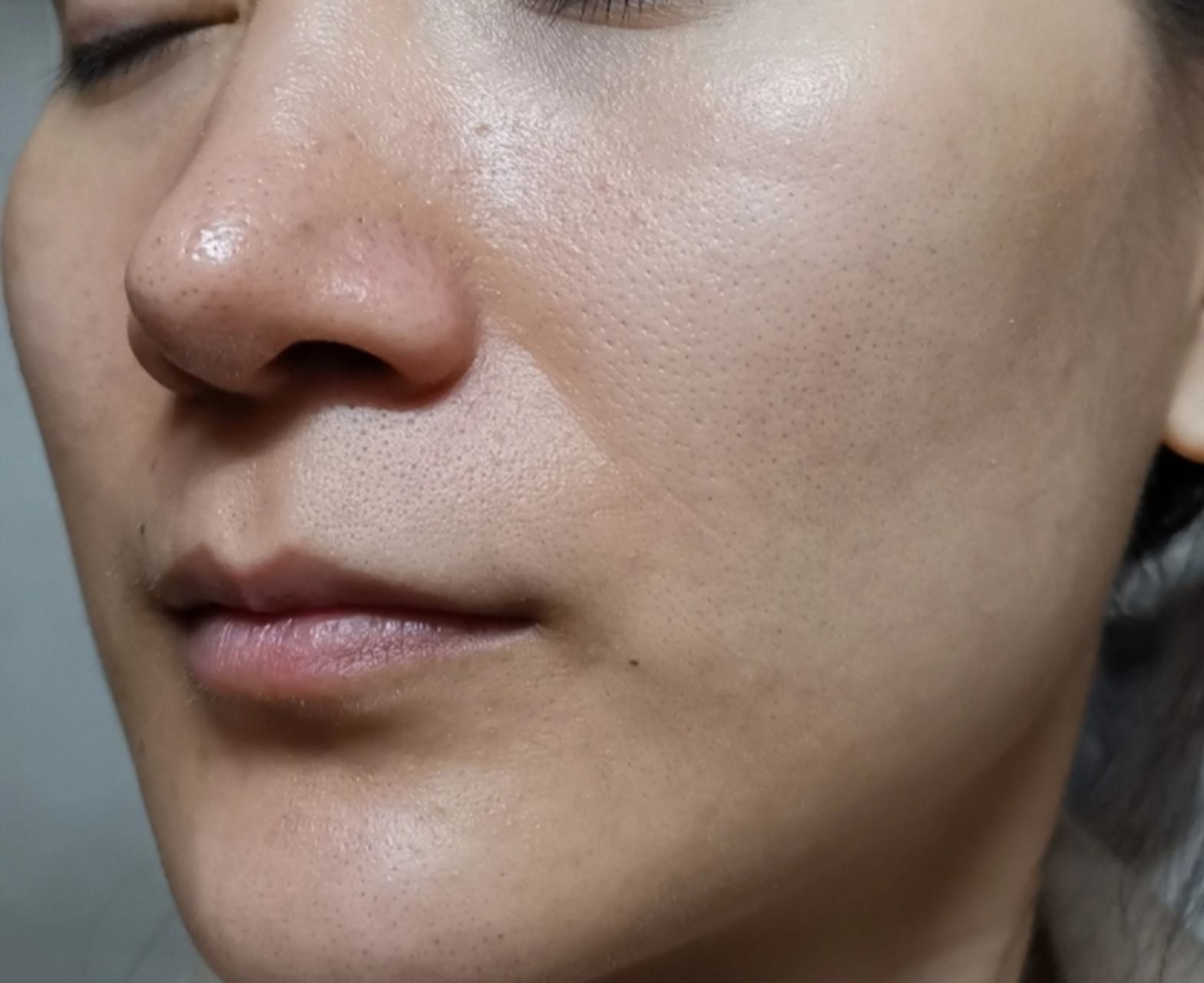 点阵激光剥脱效果图 #医美科普挑战赛#  点阵激光剥脱是一种常见的