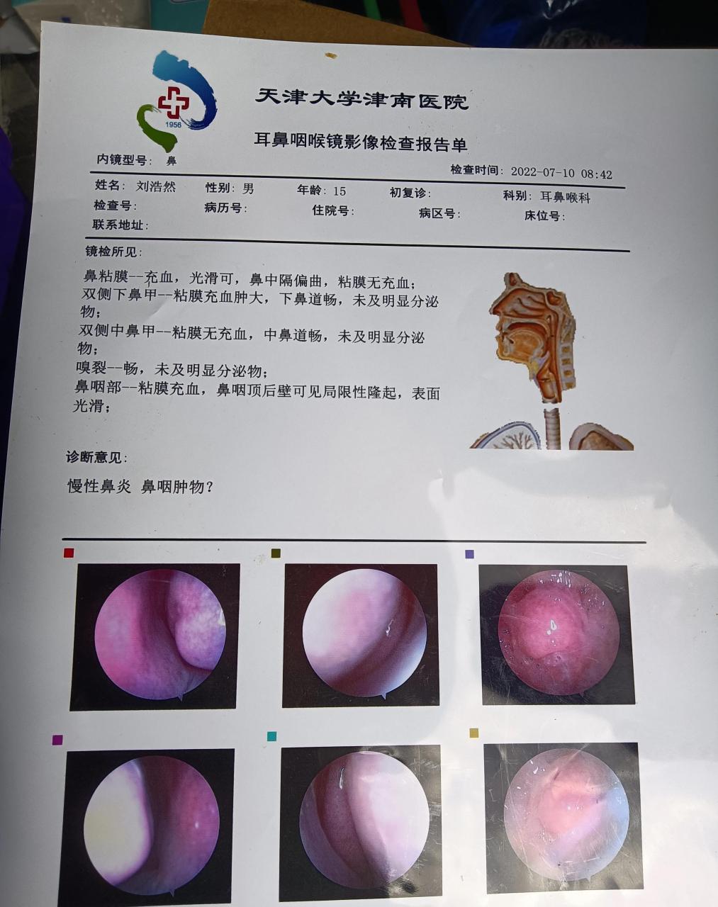 鼻窦炎真实图片