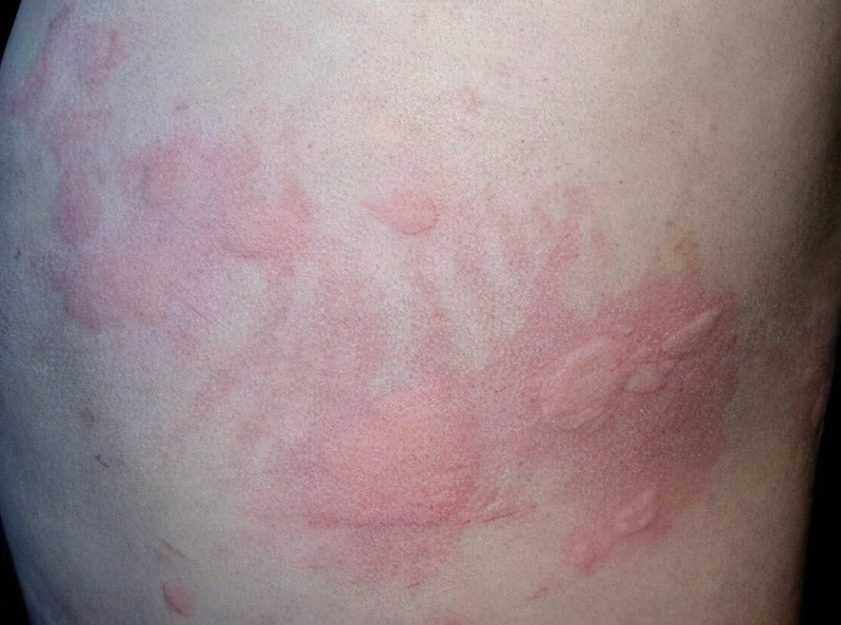 荨麻疹俗称风疹块,是由于皮肤粘膜小血管扩张及渗透性增加而出现的