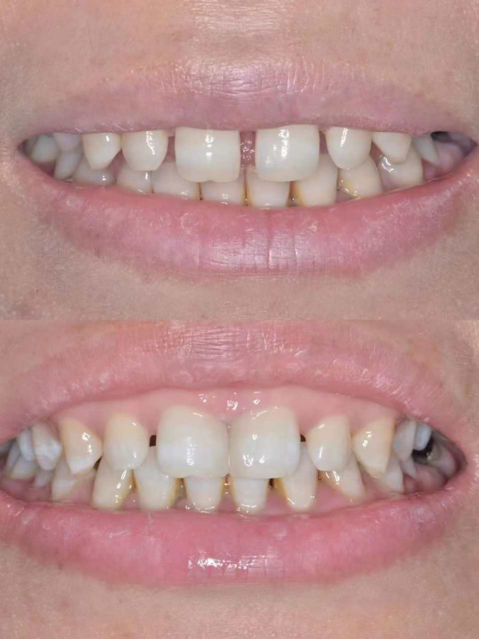 今日分享意大利美学美塑树脂,门牙美学分层牙缝修补 #昆明牙齿修复