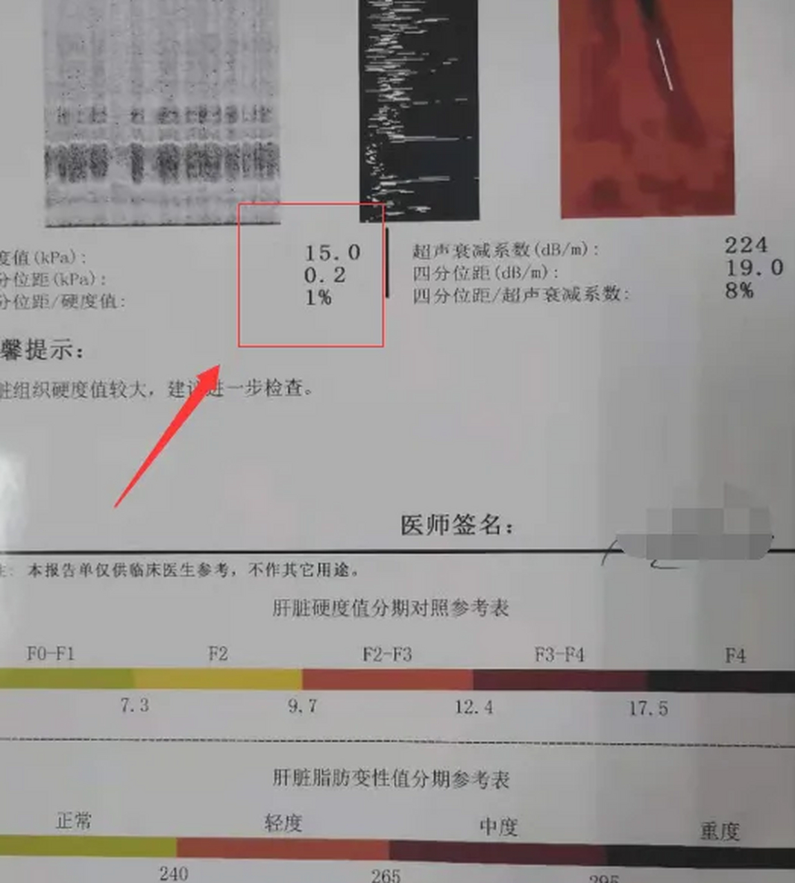 1.正常范围 7.3kpa 2.纤维化阶段:7.3-9.7kpa 3.