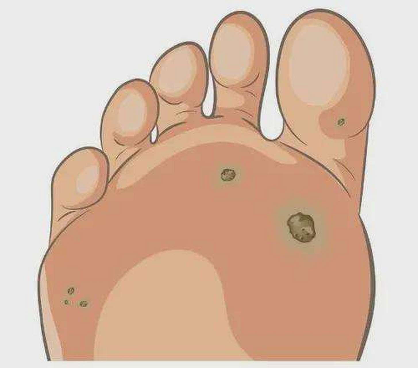 跖疣# #皮肤科# 跖疣是人乳头瘤病毒感染,即hpv病毒引起的,它会侵入