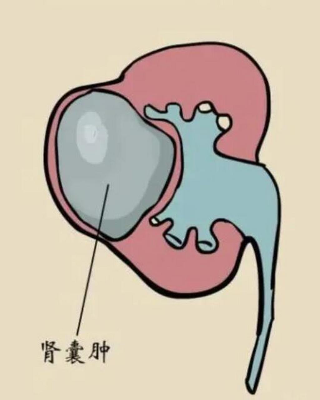 医生:小的不用治,大的可以考虑这几种方法 肾囊肿是一种较为常见的