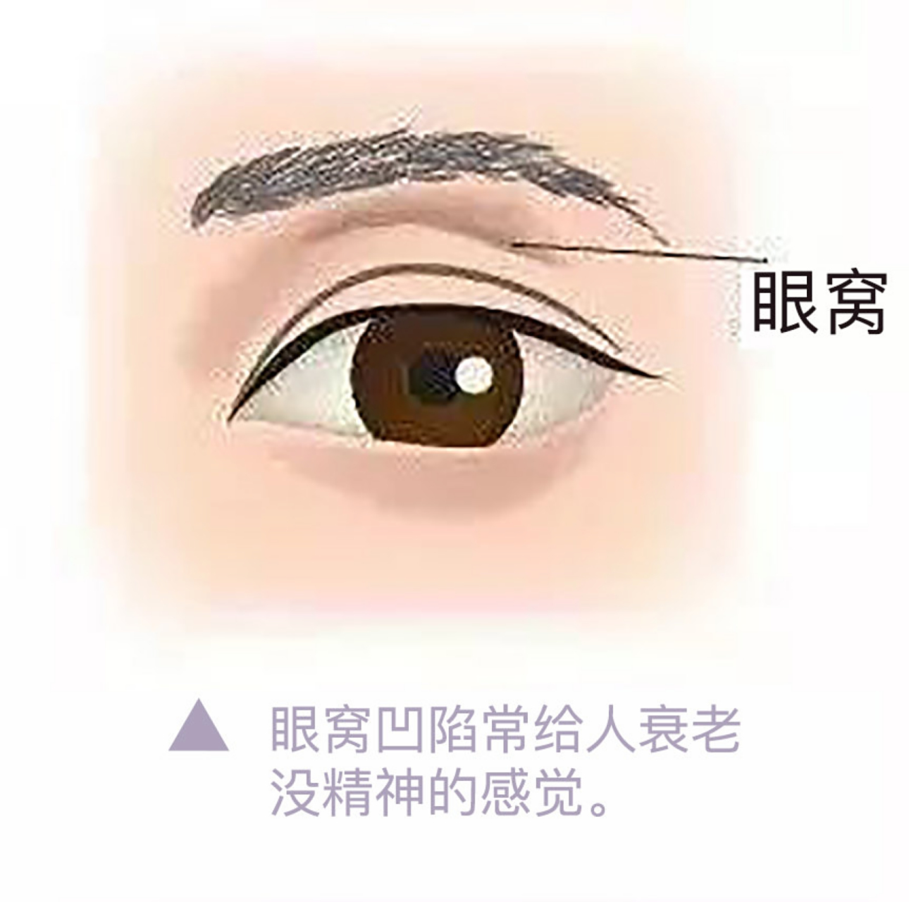 填充物可以填补凹陷区域,使眼睛看起来更加年轻和充满活力.