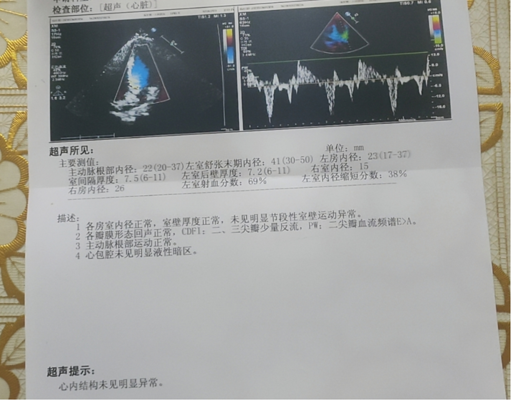 两个月,左心室射血分数提高到45%,恢复正常!