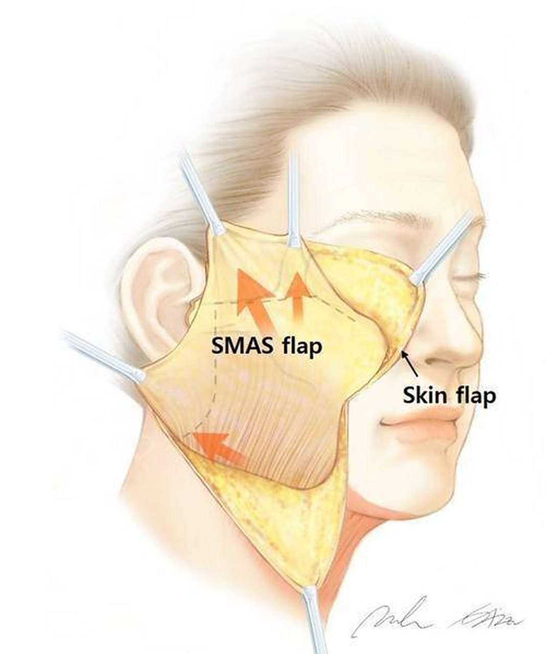 没有做smas层筋膜提升的拉皮,都是假拉皮!