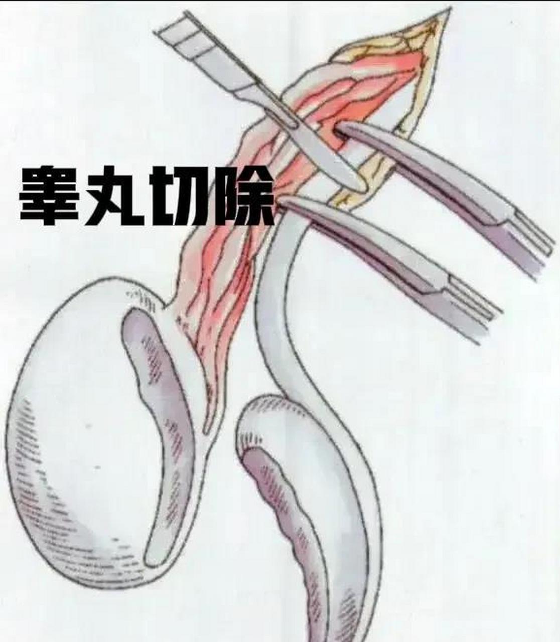 自切睾丸男子图片