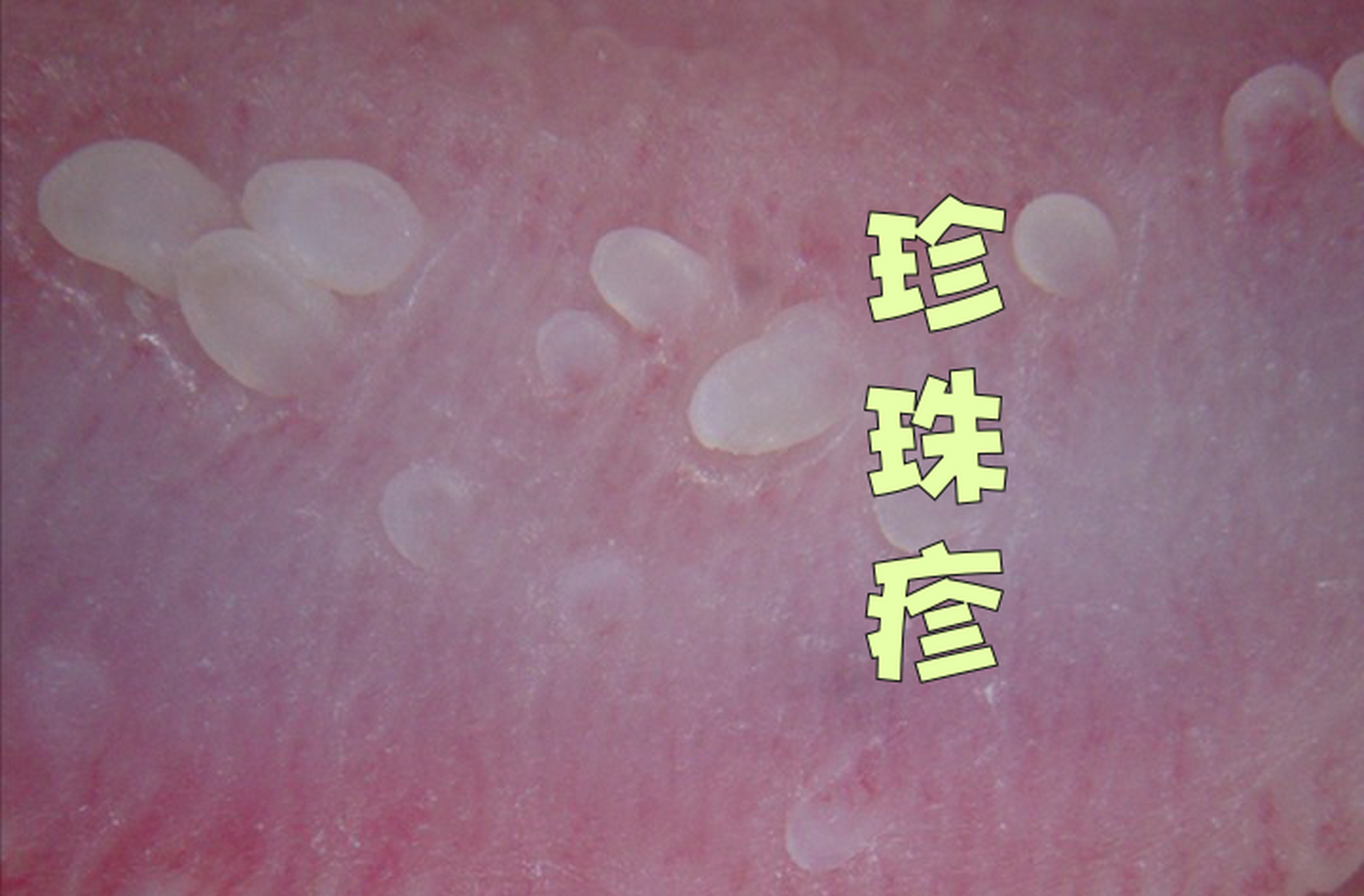 私密之处长疙瘩,不一定是尖锐湿疣.