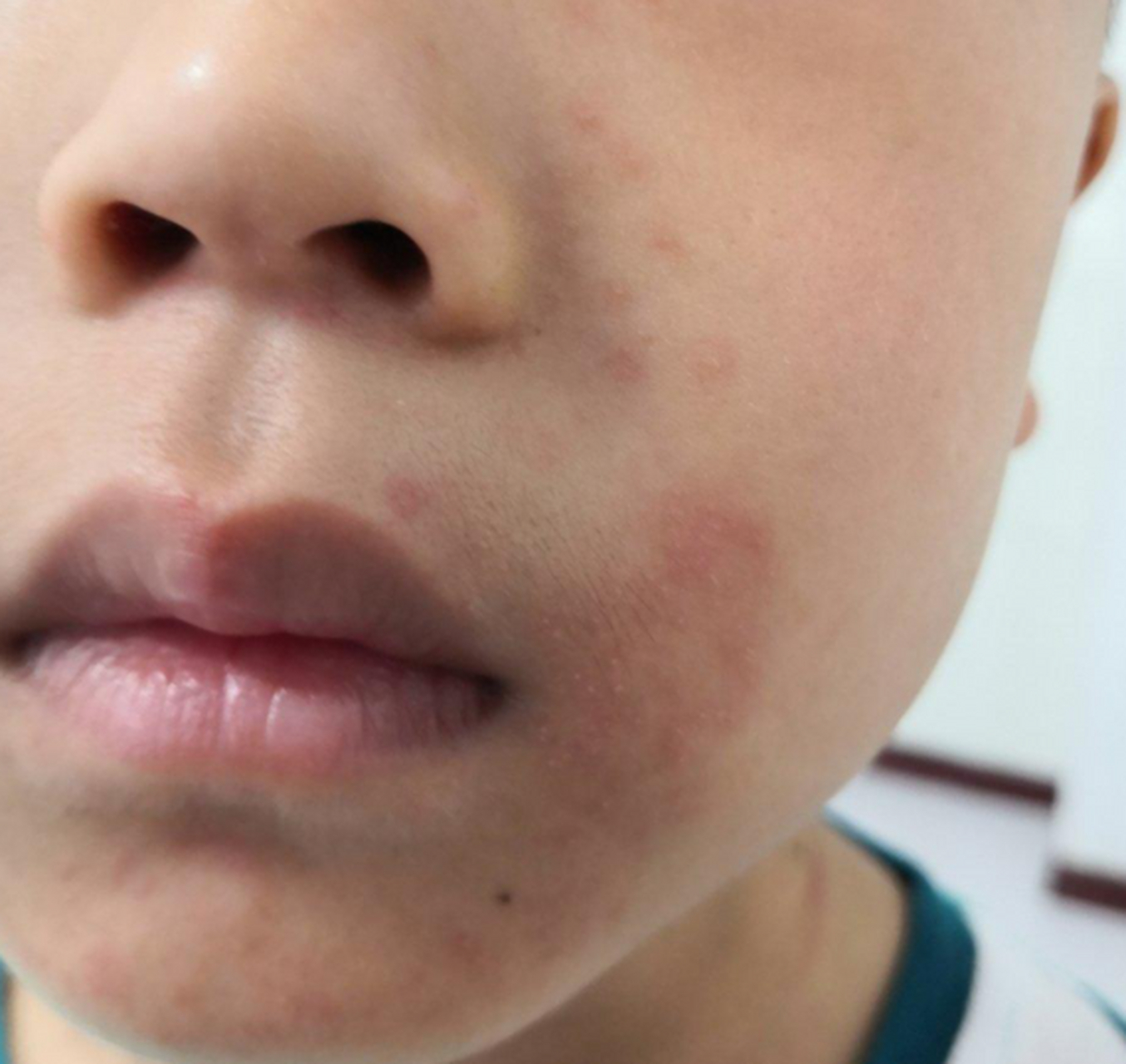 口周或者脸部出现红斑,可能要考虑到口周皮炎的问题,要及时去就医