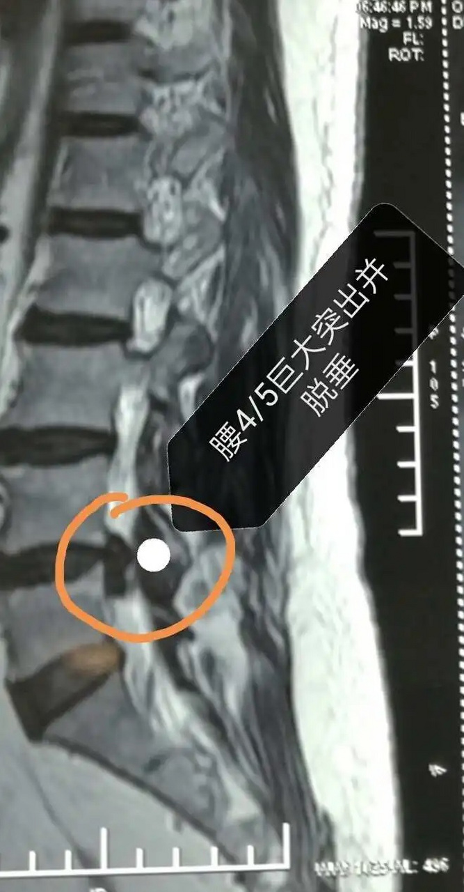 腰椎4/5突出人群注意了,疼得厉害时,2招可缓解 腰椎间盘突出的患者中