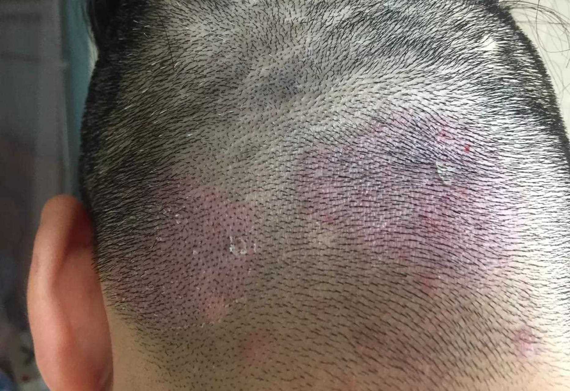 请教各位医科大神,我头上这个顽固性脂溢性皮炎有没有方法可以治疗好