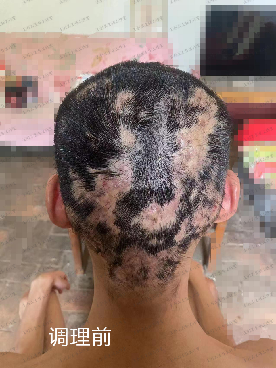 小伙子穿掘性毛囊炎伴脱发,这次受益中医,总算长出头发了!