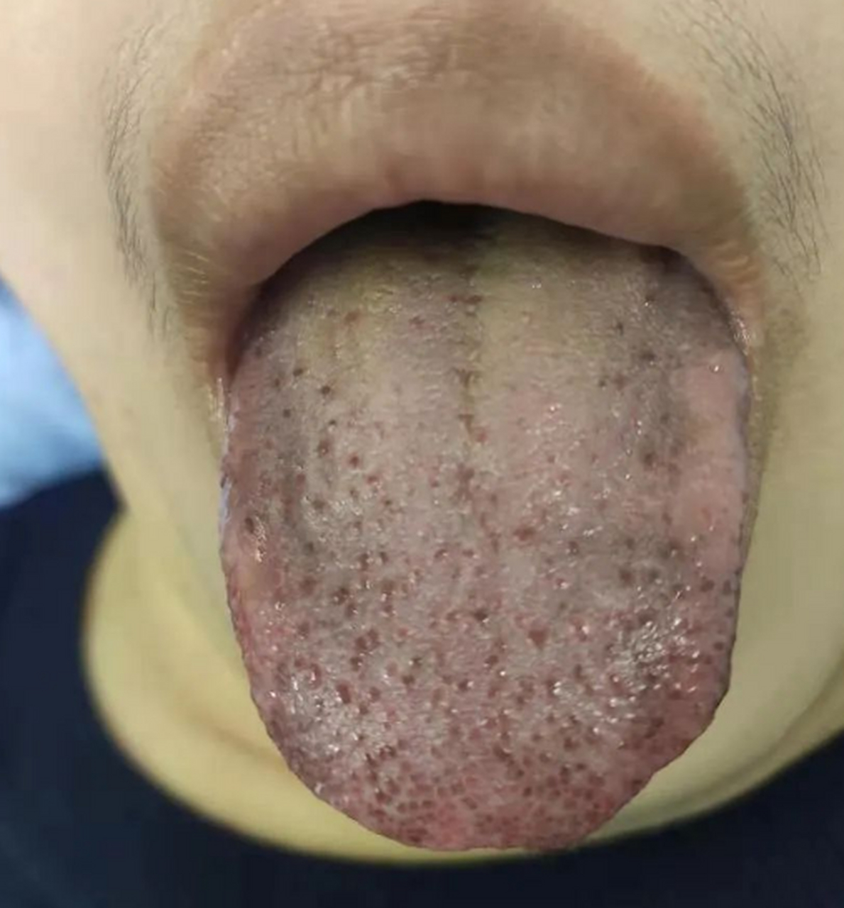 肝病舌头两侧图片图片