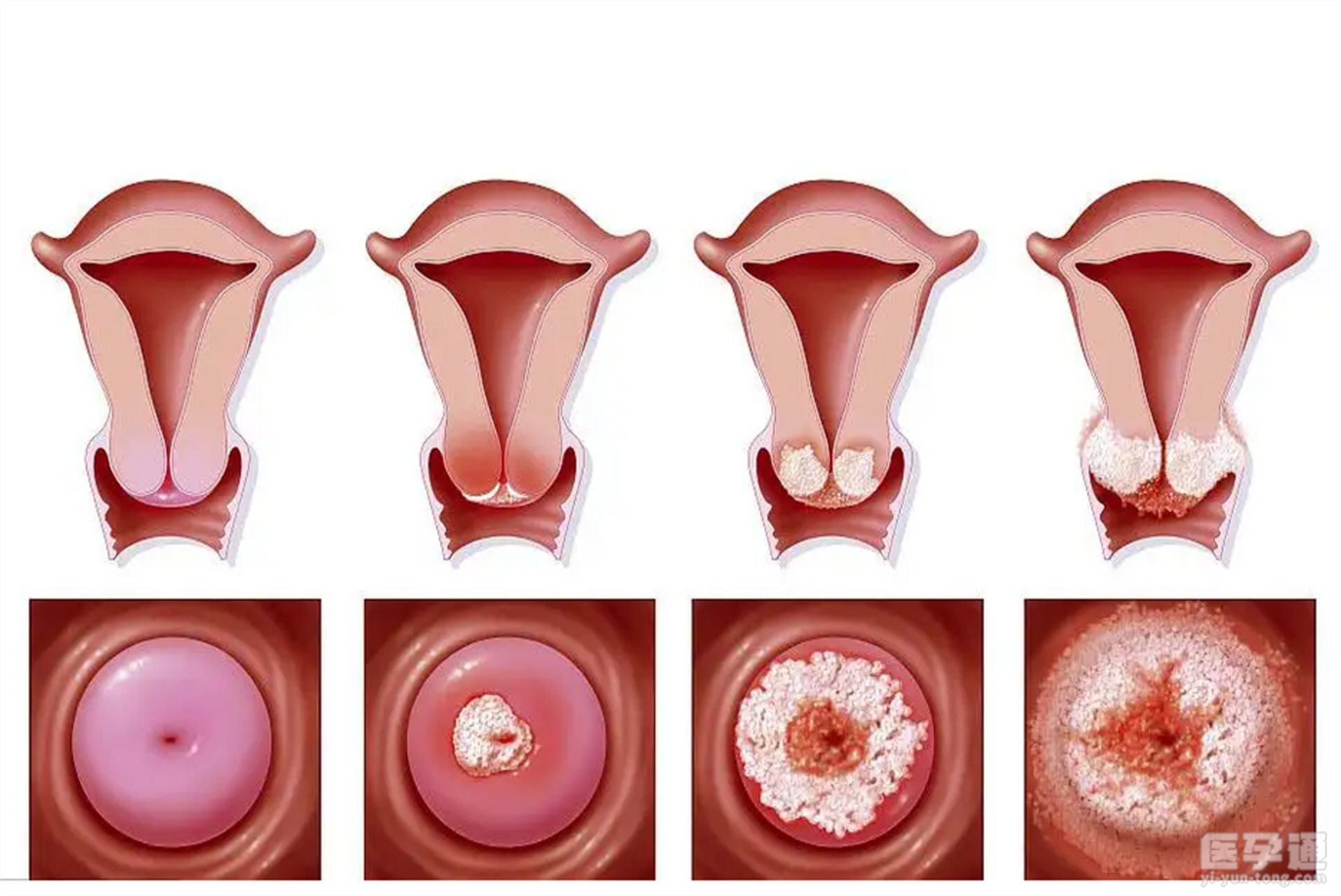 一度宫颈糜烂:白带略增多,常容易被忽略. 2.