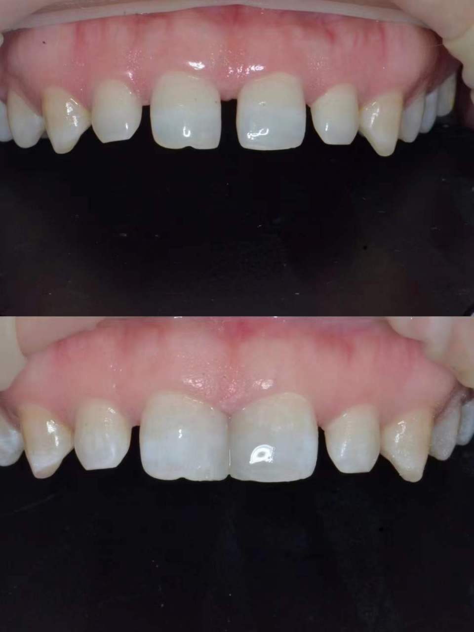 今日分享意大利美学美塑树脂,门牙美学分层牙缝修补 #昆明牙齿修复