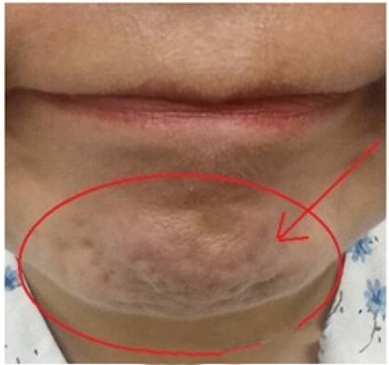 下巴其实根据我们面部五官的美学来说是有点短的,下巴也有明显的颏纹