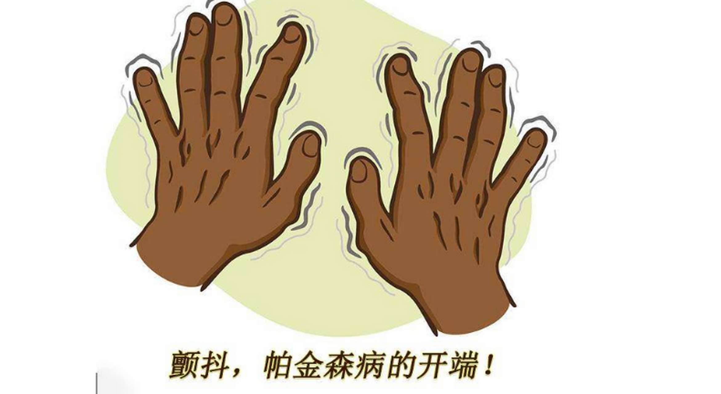 帕金森晚期死前征兆?